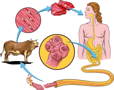 1 фото-Цистоцеркоз или тениоз – это... - face.massage.irk | Facebook