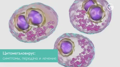 Что такое цитомегаловирус, и насколько он опасен? Об этом заболевании  рассказывает заведующая терапевтическим.. | ВКонтакте