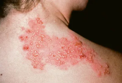БОЛЕЗНЬ ЖИБЕРА 👉🏻 РОЗОВЫЙ ЛИШАЙ ⠀ Розовый лишай — дерматологическое  заболевание, чаще возникает в межсезонье, проявляет себя… | Instagram