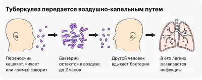 Туберкулез (ТБ) - Признаки, симптомы и лечение туберкулеза