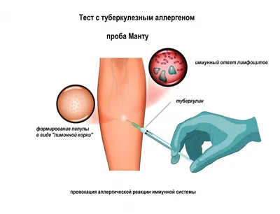 Информация о туберкулезе | Детский сад №227