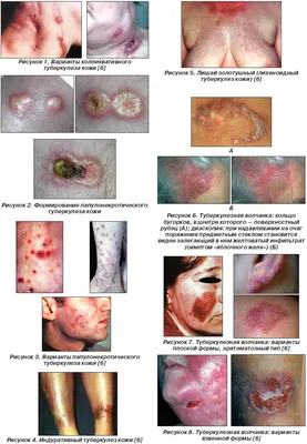 Туберкулез кожи фото лечение фото