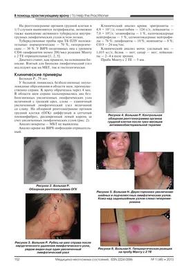 Туберкулез кожи: фото, причины, симптомы, диагностика и лечение
