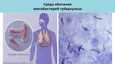 Инфильтративный туберкулез легких - фазы, причины, формы, симптомы,  диагностика, лечение, прогноз