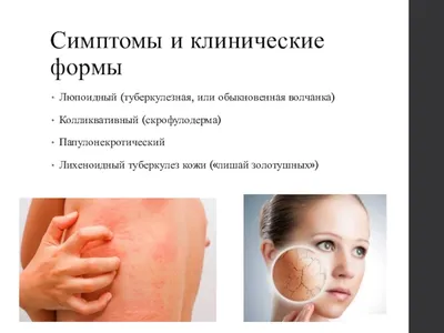 Туберкулез кожи - презентация онлайн