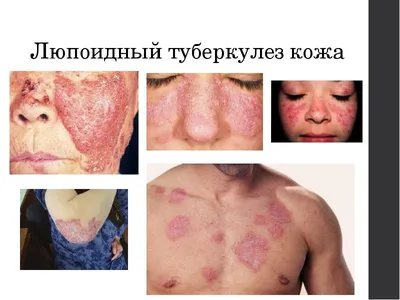 Лепра, лейшманиоз, туберкулез кожи | Презентации Дерматовенерология |  Docsity