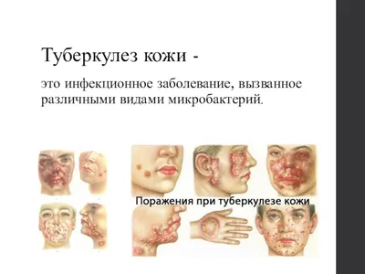 Медицинская иллюстрация туберкулеза кожи изображение_Фото номер  401869192_PSD Формат изображения_ru.lovepik.com