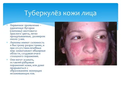 Туберкулез кожи и его виды: фото, симптомы и основные причины