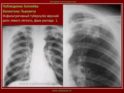 Рентгеновский снимок по фтизиатрии | Пикабу