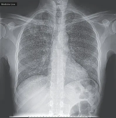 Туберкулёз Легких Правом Верхнем Лёгком стоковое фото ©YAY_Images 617985144