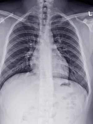 Туберкулёз. Инфильтративный туберкулёз. + | Портал радиологов