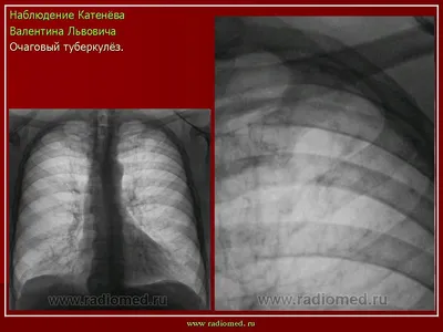 Ответ на пост «Из жизни рентгенолога. Часть 7. Туберкулезный ликбез.» |  Пикабу
