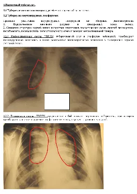 Туберкулёз: Лучевая диагностика | ТБ Инфо