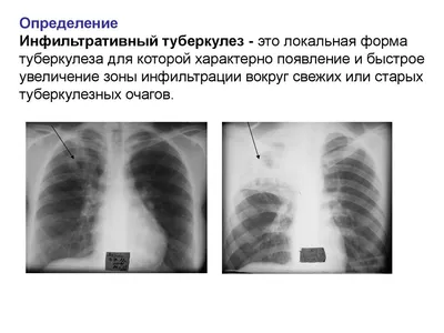 Инфекционные болезни - Туберкулез у больных ВИЧ-инфекцией в терапевтическом  стационаре в регионе с высокой пораженностью ВИЧ Цель. Изучить характер и  место туберкулеза (ТБ) в структуре заболеваний органов дыхания у больных  ВИЧ-инфекцией в