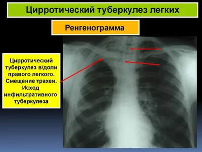 В Молдове обследуют людей, особо уязвимых для туберкулеза и рака