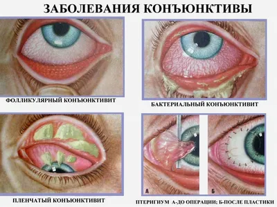 Симптомы и лечение фликтенулезного конъюнктивита - энциклопедия Ochkov.net