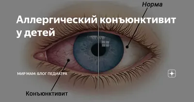 Что делать, если начался затяжной конъюнктивит? - энциклопедия Ochkov.net