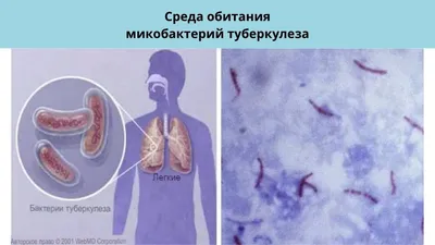 ФАРМАТЕКА » Распространенная скрофулодерма и диссеминированный туберкулез  легких на фоне ВИЧ-инфекции