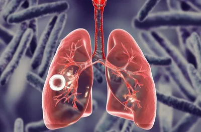 Кавернозный туберкулез - причины появления, симптомы заболевания,  диагностика и способы лечения