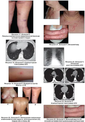 Туберкулез кожи и подкожной клетчатки.  http://tuberculum.ru/tuberkulez-kozhi-i-podkozhnoj-kletchatki | ВКонтакте