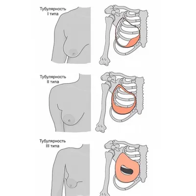 Увеличение тубулярной груди - Исамутдинова Г. М.