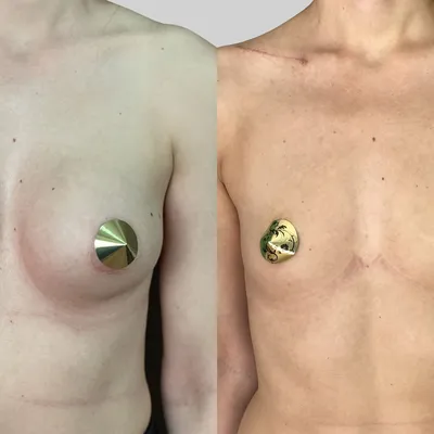 Коррекция тубулярной груди в Москве - цены, отзывы, реальные фото до и  после | Александр Маркушин пластический хирург