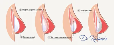 Коррекция тубулярной груди в Москве - цены, отзывы, реальные фото до и  после | Александр Маркушин пластический хирург