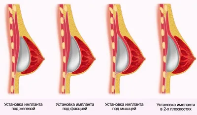 Тубулярная грудь у женщин: как выглядит и как исправить с операцией и без