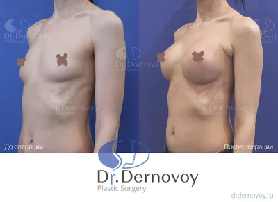Пластика тубулярной груди в Москве - Damas Medical Center