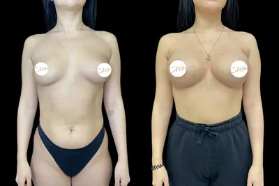 Как исправить тубулярную форму груди? Методы лечения / 18+ - YouTube