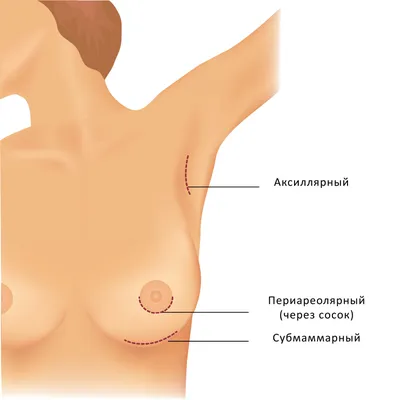 BellaGel.Russia - Врожденная патология молочных желез, исправить которую  мечтают многие женщины — это тубулярность (туберозность) груди. Основной  показатель туберозной деформации — грудь в виде трубок, а не привычных  полусфер. Такая форма груди