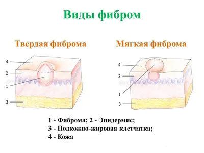 Лазерное удаление фибромы в Санкт-Петербурге недорого | Центр лазерной  эпиляции