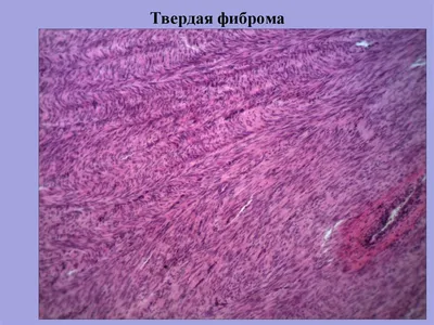 Дерматофиброма: гистология, фото, лечение | Удаление дерматофибромы кожи  лазером / скальпелем в Клинике подологии Полёт в Москве