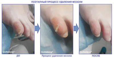 Remove the callus. Deep callus. Pedicure. Removing corns on the legs. DEEP  INVENTION - YouTube