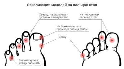 Мозоли и натоптыши на ногах. Как от них избавиться?