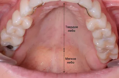 STOMWEB — Твердое и мягкое нёбо