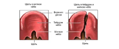 Что такое расщелина твердого неба и как помочь?