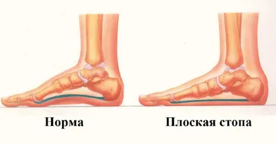 Плоскостопие ✓: симптомы, причины, диагностика и лечение