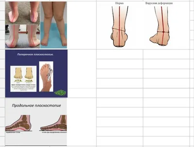 Перелом, подворот, деформация стопы | Реабилитация ONLINE | Дзен