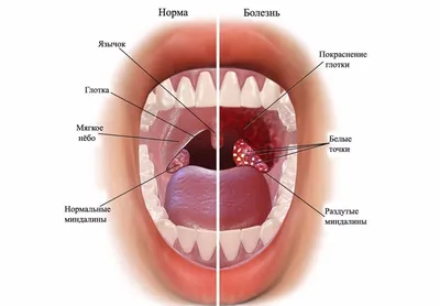 Хронический тонзиллит — симптомы, причины и методы лечения болезни