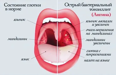 Лечение фарингита у детей в Красноярске - Лор-нэт