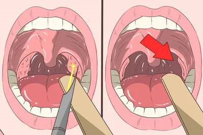 Острый и хронический тонзиллит у детей: симптомы, причины и лечение