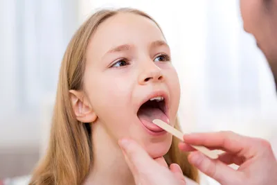 Грибковая ангина у детей: причины, симптомы и лечение