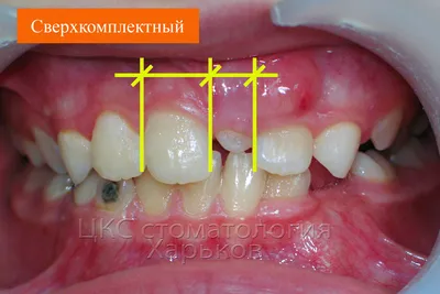 Верхний клык у ребенка растет криво, что делать? | Клиника Ортодонтика,  Москва