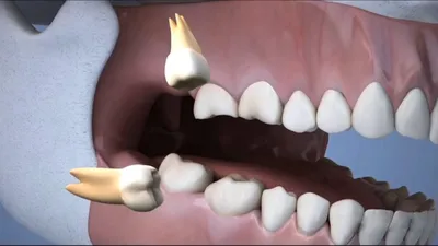 Зуб мудрости растет и болит десна: что делать, как снять боль | Dental Art