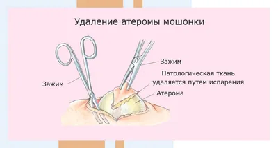 Удаление атеромы в Невском районе СПБ, ст.м. «Улица Дыбенко», пр-т  Большевиков