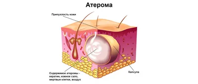 Атерома - причины появления, симптомы заболевания, диагностика и способы  лечения