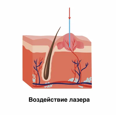 Удаление бородавки наш результат после 2 х посещения #удалиниебородавок  #лечениестоп #удалениевросшихногтей #удаланиестержневыхмазолей… | Instagram