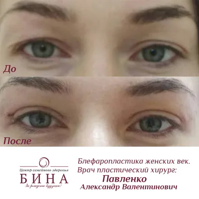 Лазерная блефаропластика Fotona Smooth Eye » Салон лазерной косметологии  \"ЛИЛУ\"