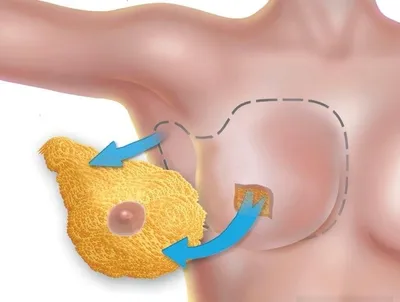 Выбор реконструкции молочной железы после мастэктомии